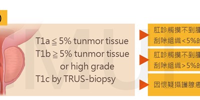 攝護腺癌於治療前之評估