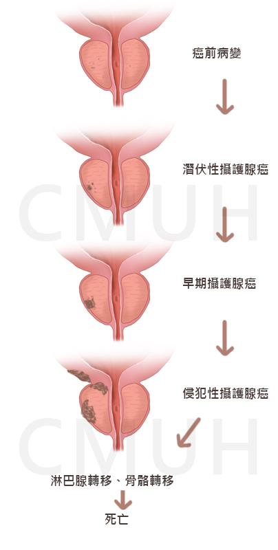 攝護腺癌的新診斷