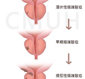攝護腺癌的新診斷