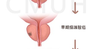 攝護腺癌的新診斷