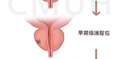 攝護腺癌的新診斷