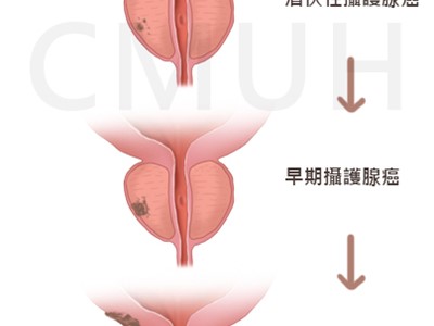 攝護腺癌的新診斷