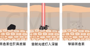銣雅鉻雷射除斑