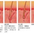 除毛雷射