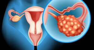 提高卵巢癌療效 腹腔內化療溫熱療法巧妙助攻