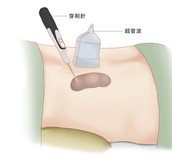 認識淋巴瘤