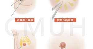 男性女乳手術