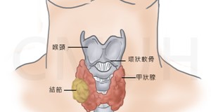 甲狀腺結節