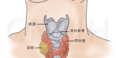 甲狀腺結節
