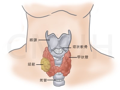 甲狀腺結節