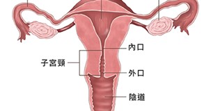 子宮內膜異位症