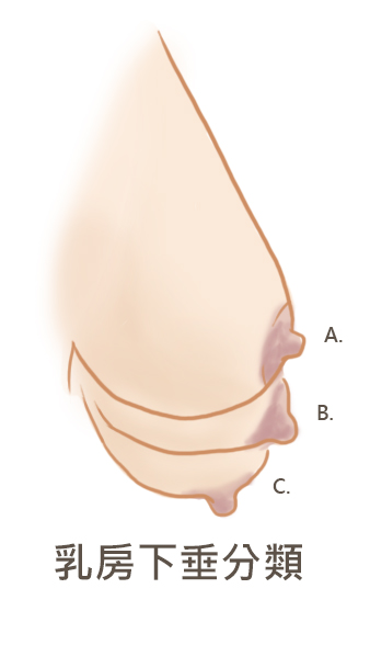 乳房下垂分類