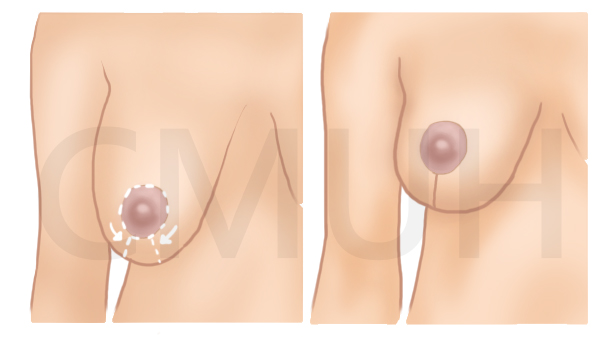 提乳手術1