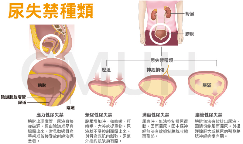 至於「過動性膀胱」族群，由於對溫度敏感，要注意天氣變冷時適當保暖，可減少對膀胱的刺激