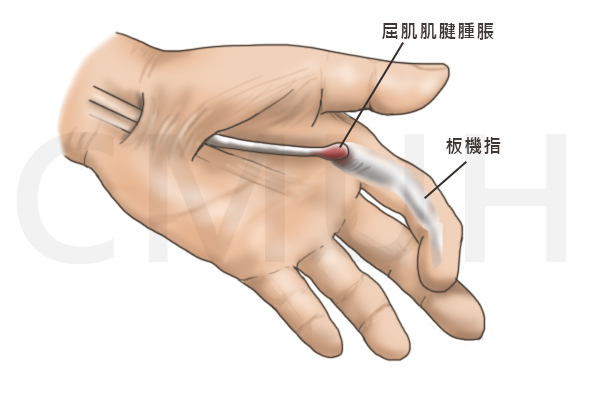 扳機指 中亞健康網 用心傳遞每一刻為您把關健康人生