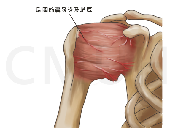 五十肩