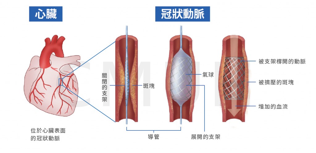 冠狀動脈介入治療