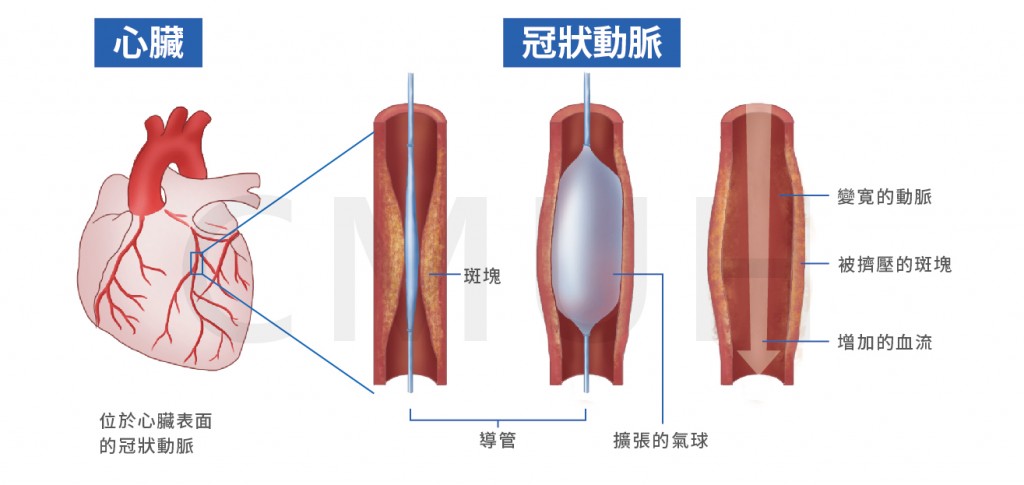 冠狀動脈介入治療