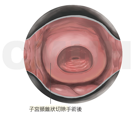 子宮頸圓錐狀切除術