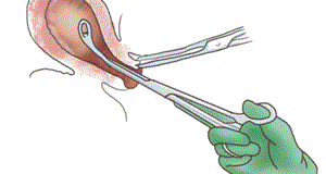 子宮頸擴張及子宮內膜搔刮手術