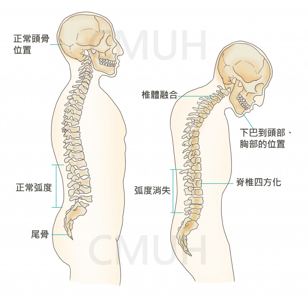 僵直性瘠椎炎