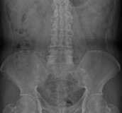 遺傳性僵直性脊椎炎應及早檢測