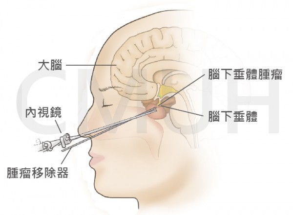 庫欣氏症