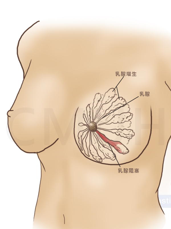 乳腺阻塞