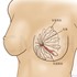 乳腺管阻塞照護