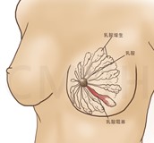 乳腺管阻塞照護