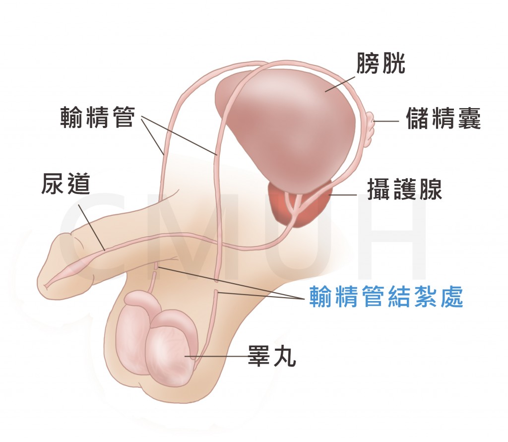 輸精管結紮